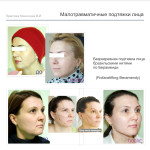 Малотравматичные подтяжки лица